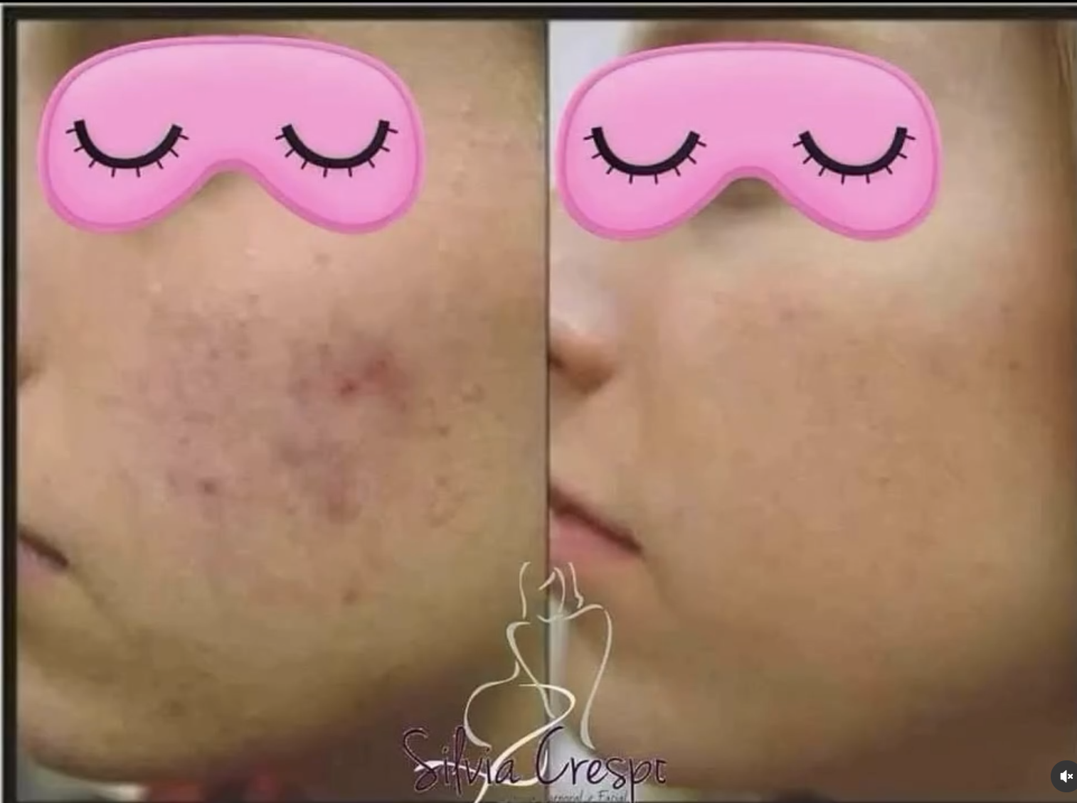Resultado de tratamento de ozonioterapia e estética avançada